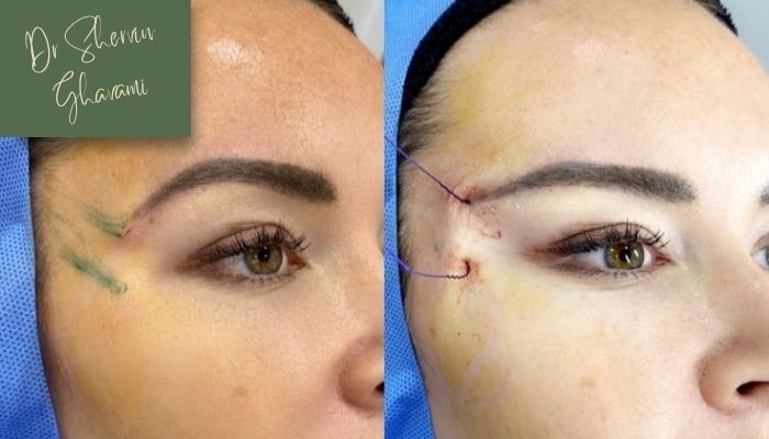 لیفت شقیقه با نخ