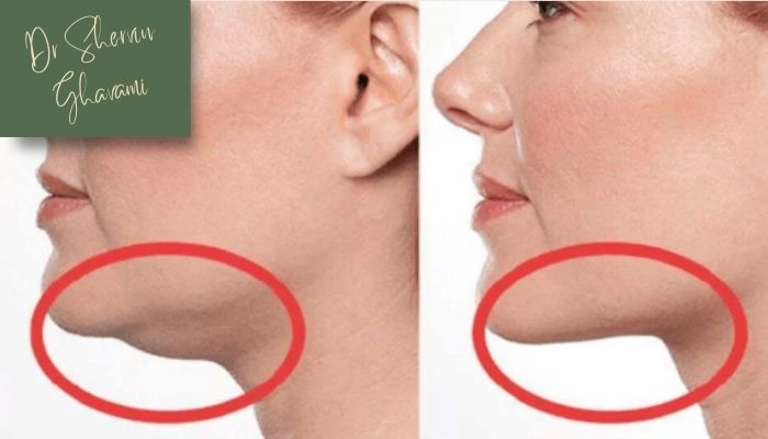 دکتر قوامی بهترین متخصص ساکشن غبغب در سعادت‌آباد تهران