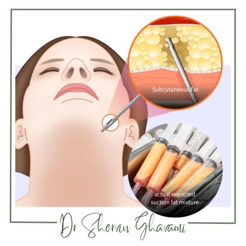 مزایای جراحی ساکشن غبغب