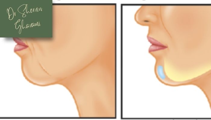 دلایل انجام پروتز چانه