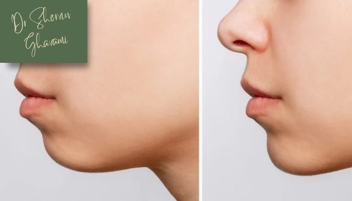 افراد مناسب برای انجام پروتز 