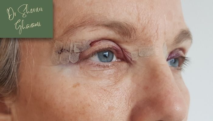 انواع عمل بلفاروپلاستی