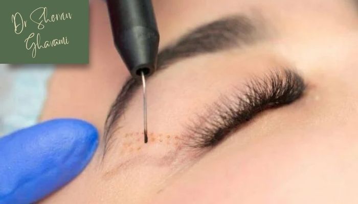 مزایای بلفاروپلاستی با لیزر  مزایای بلفاروپلاستی با لیزر