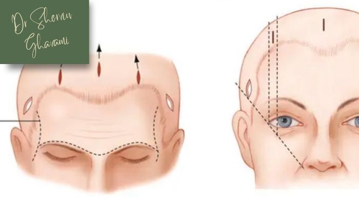 تأثیر لیفت شقیقه بر درمان افتادگی ابرو تأثیر لیفت شقیقه بر درمان افتادگی ابرو