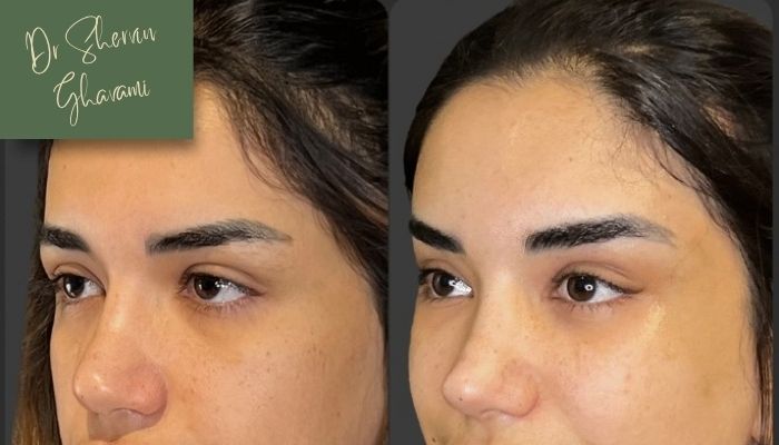 نتایج و دوام اثر لیفت بر افتادگی ابرو نتایج و دوام اثر لیفت بر افتادگی ابرو