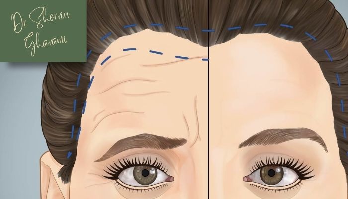 آیا بعد از لیفت شقیقه فرم چشم تغییر میکند؟ آیا بعد از لیفت شقیقه فرم چشم تغییر میکند؟