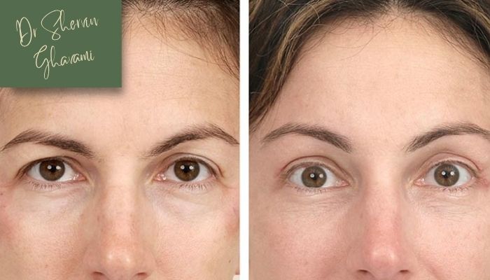 تفاوت لیفت با سایر روشها تفاوت لیفت با سایر روشها