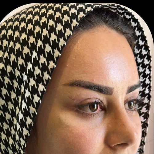 لیفت شقیقه