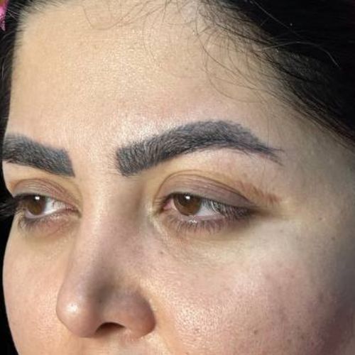 لیفت شقیقه
