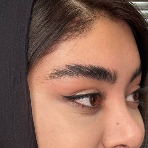 لیفت شقیقه