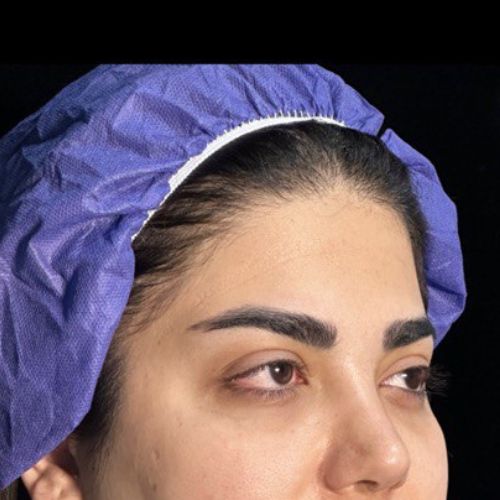لیفت شقیقه
