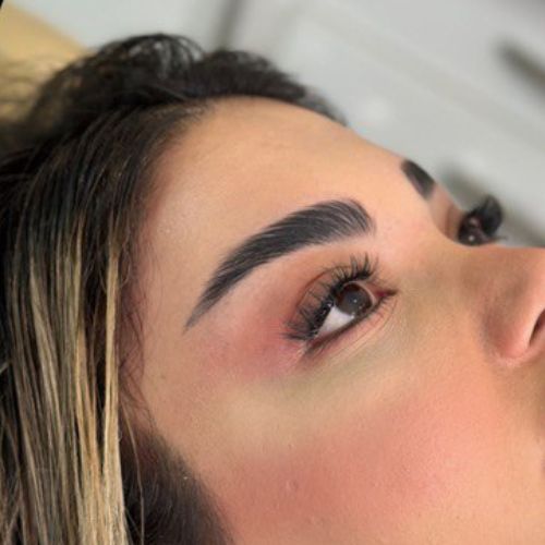 لیفت شقیقه