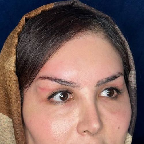 بلفاروپلاستی