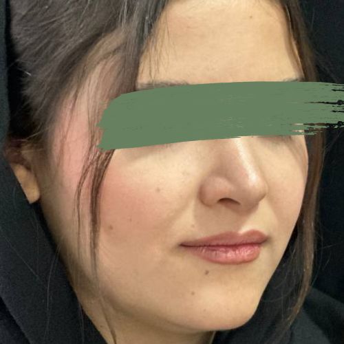 رینوپلاستی