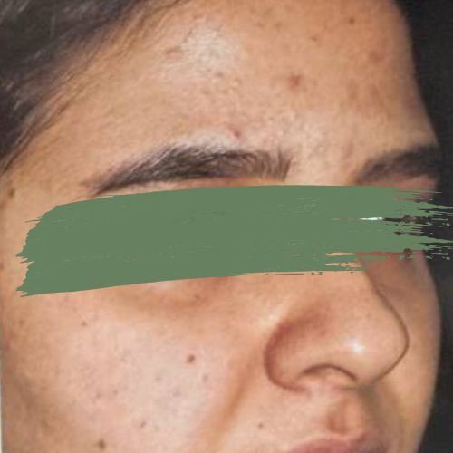 رینوپلاستی