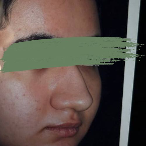 رینوپلاستی