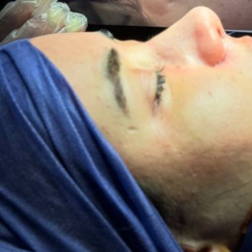 رینوپلاستی