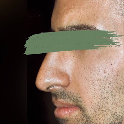 رینوپلاستی