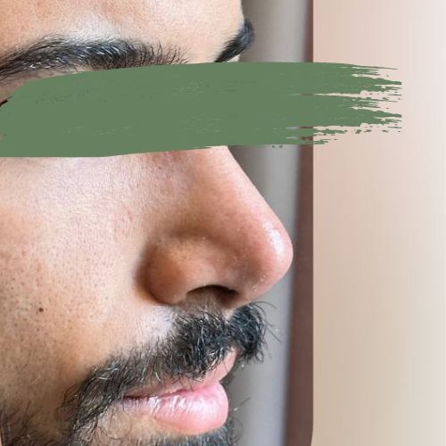 رینوپلاستی