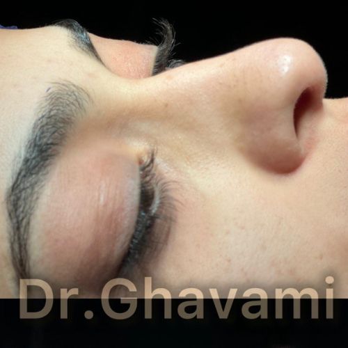 رینوپلاستی