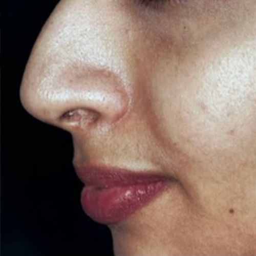 رینوپلاستی