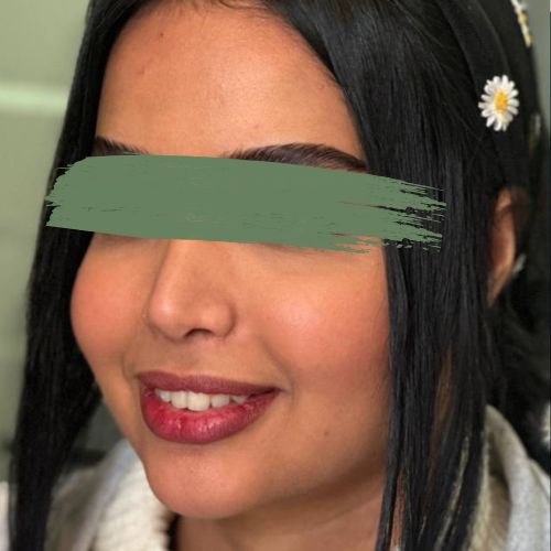 رینوپلاستی