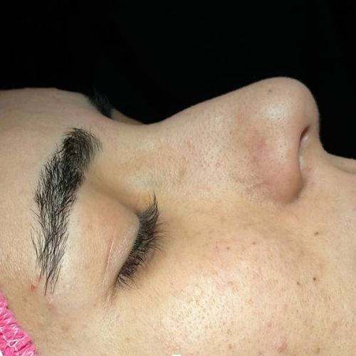 رینوپلاستی