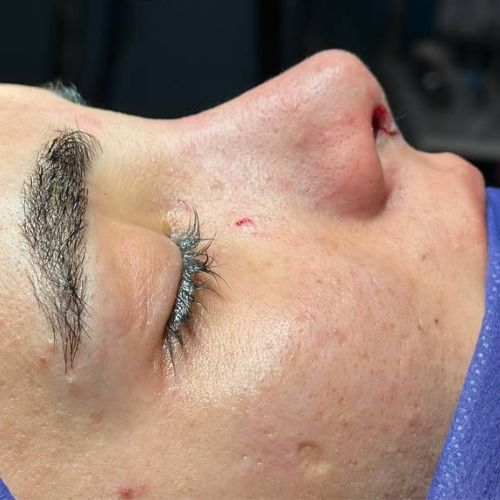 رینوپلاستی