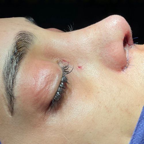 رینوپلاستی