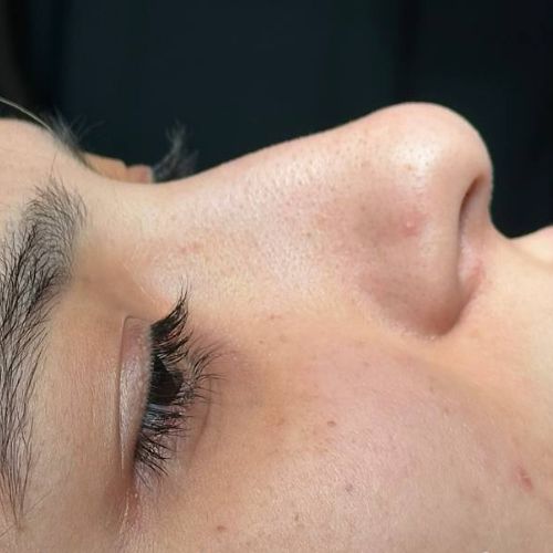 رینوپلاستی