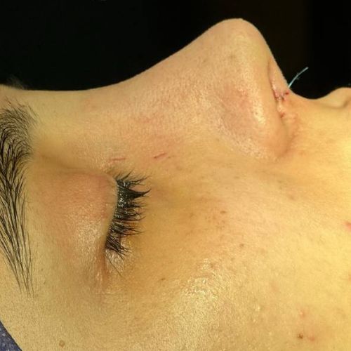 رینوپلاستی