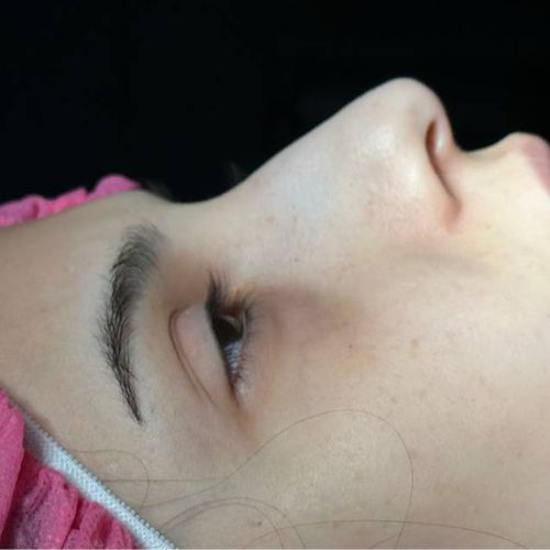 رینوپلاستی