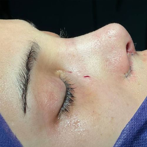 رینوپلاستی