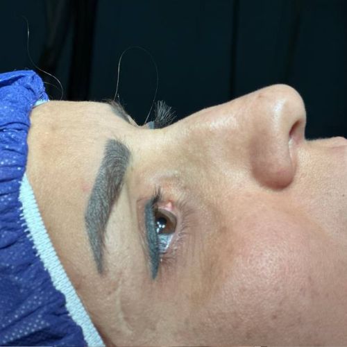 رینوپلاستی