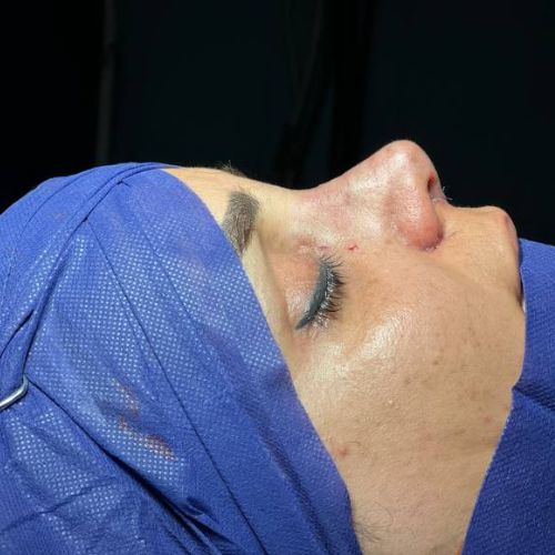 رینوپلاستی