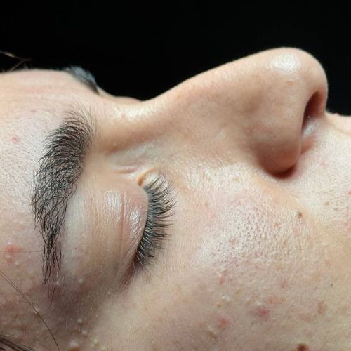 رینوپلاستی