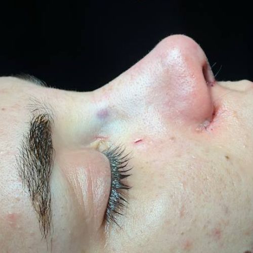 رینوپلاستی