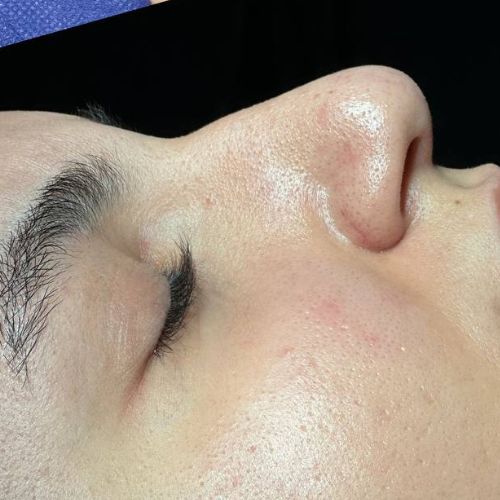 رینوپلاستی