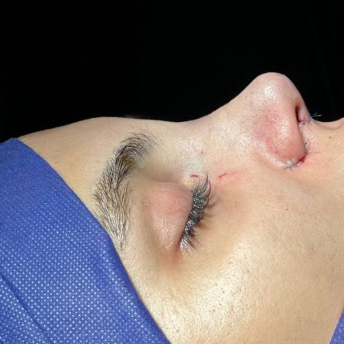 رینوپلاستی