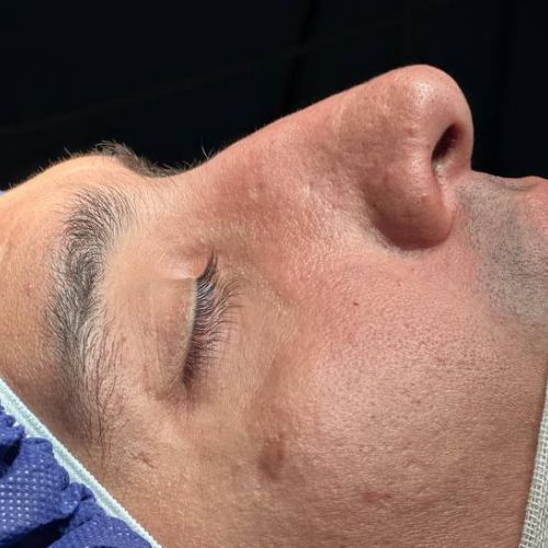 رینوپلاستی