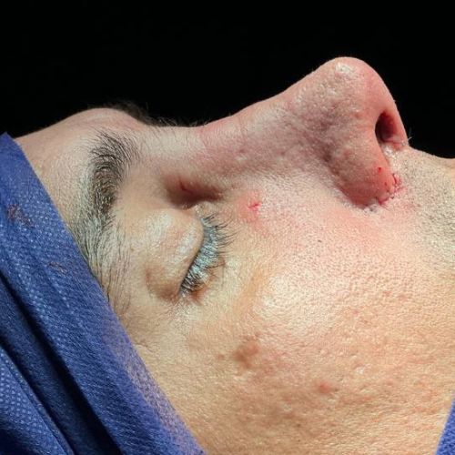 رینوپلاستی