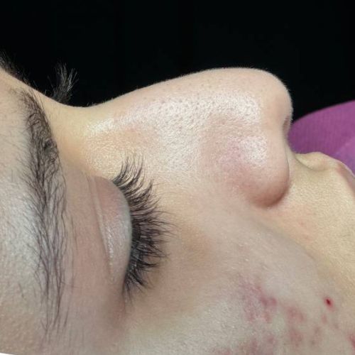 رینوپلاستی