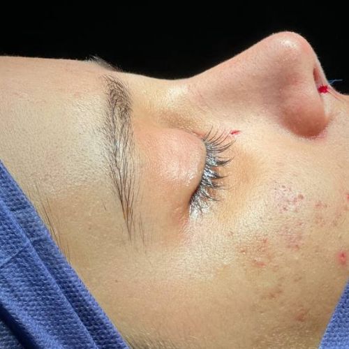 رینوپلاستی