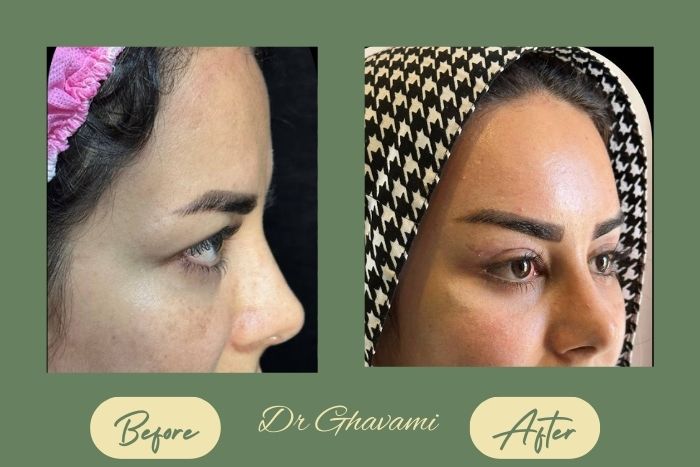 لیفت شقیقه 5