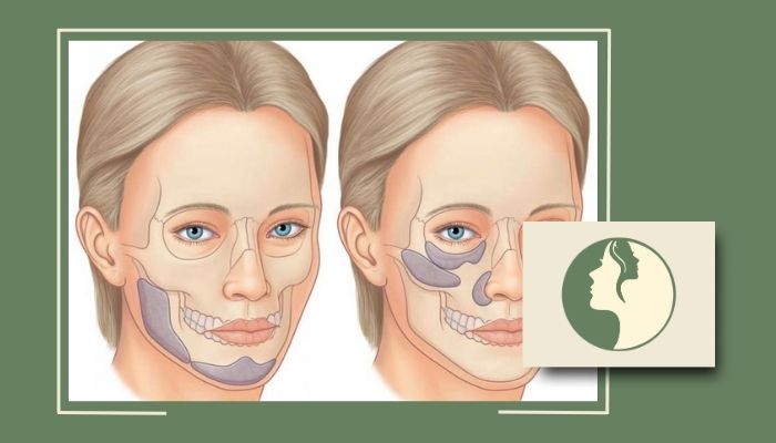 ماندگاری پروتز گونه و چانه چقدر است؟ آیا دائمی است؟