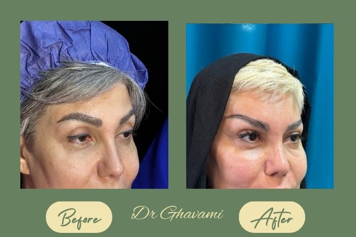 لیفت شقیقه لیفت شقیقه