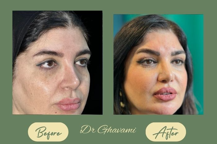 لیفت شقیقه لیفت شقیقه