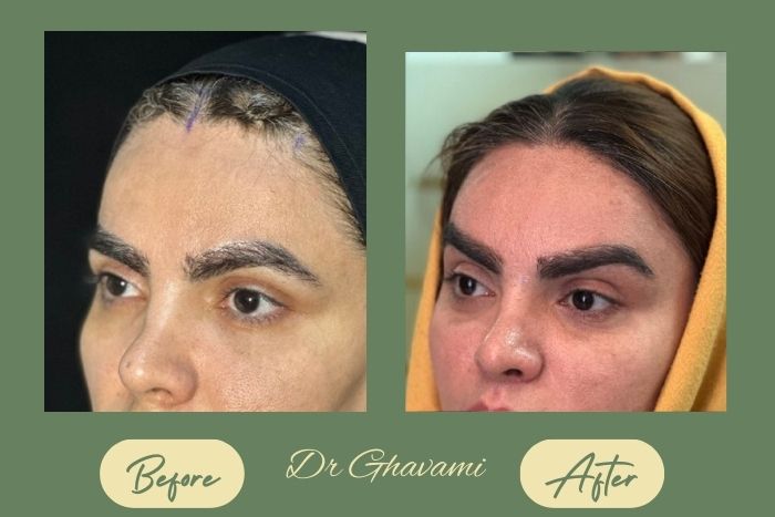 لیفت شقیقه لیفت شقیقه