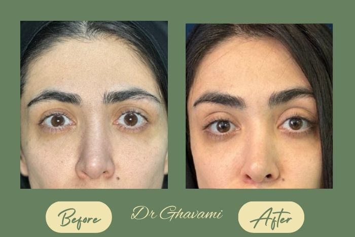 لیفت شقیقه لیفت شقیقه