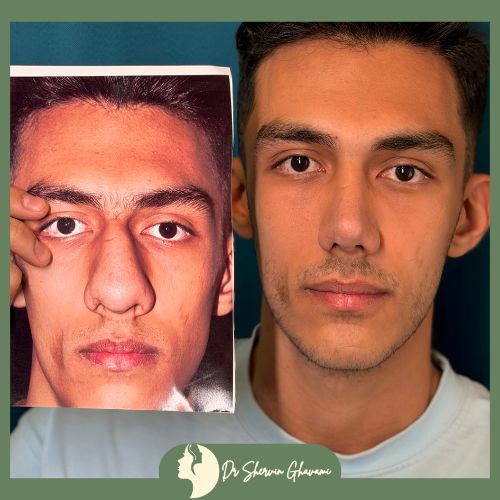 جراحی بینی گوشتی جراحی بینی گوشتی
